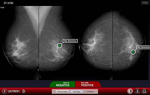 breastscreen nsw