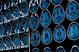 Brain scans of concussed athletes