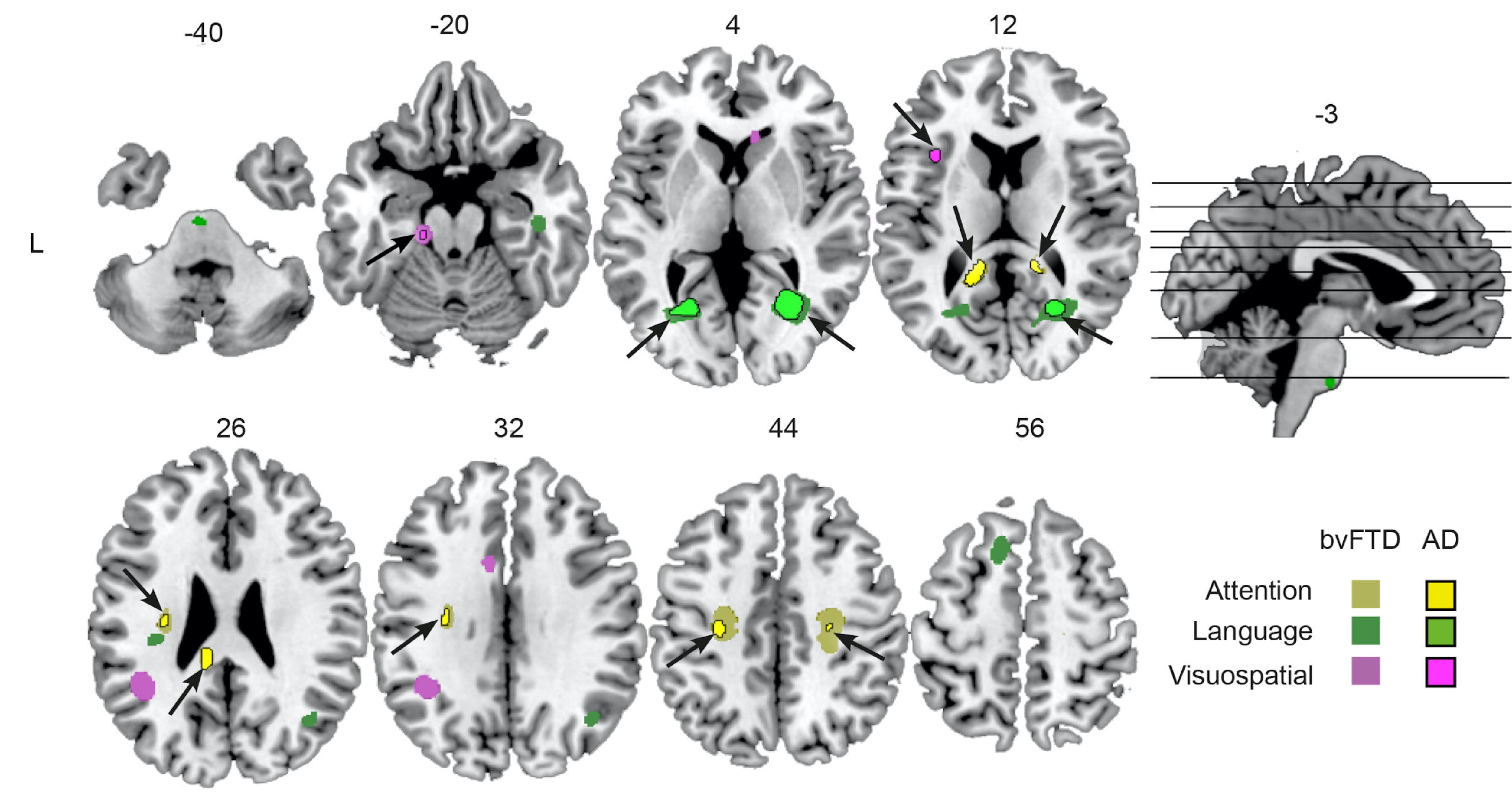 white-matter-changes-in-brain-found-in-frontotemporal-dementia-the