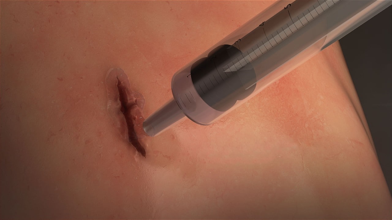 A gel being squirted onto a wound using a syringe.