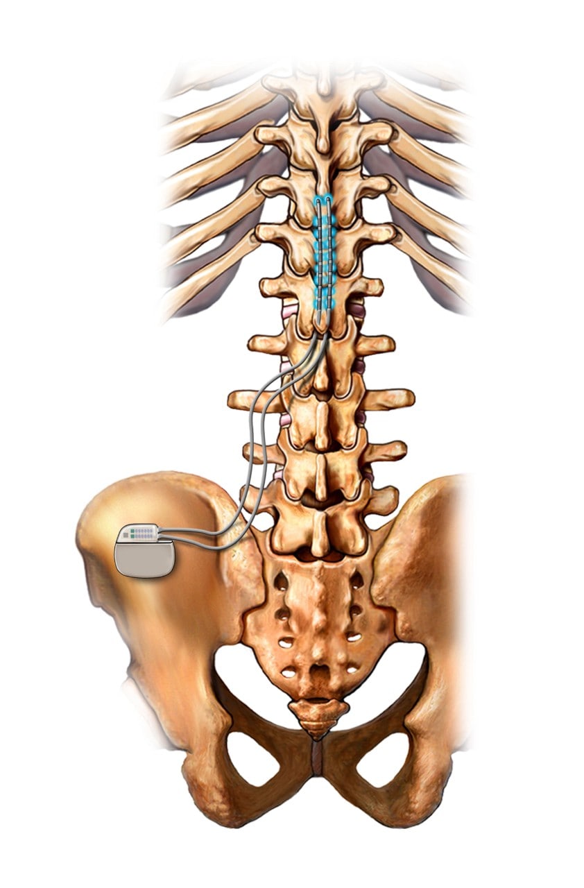 Q&A: Back pain post-surgery? Try a spinal cord stimulator